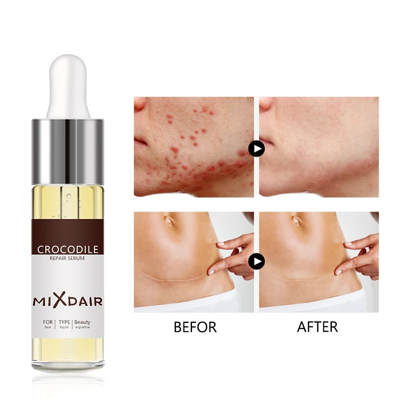 2019 Repair Scar Face Serum Removal Acne Scar Whitening for Spots Acne