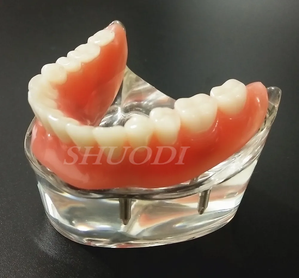 

Dental Overdenture Interior Mandibular Lower with 4 Implants Restoration Teeth Study Teach Model