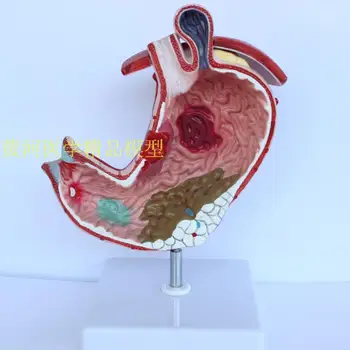

Human stomach anatomy model pathological stomach model gastric pathology