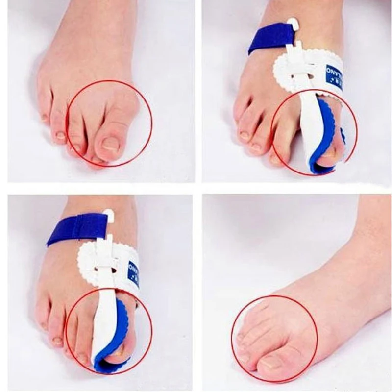 1pair Bunion Device Hallux Valgus Orthopedic Braces Toe Correction Night Foot Care Corrector Thumb Big Bone Orthotics H