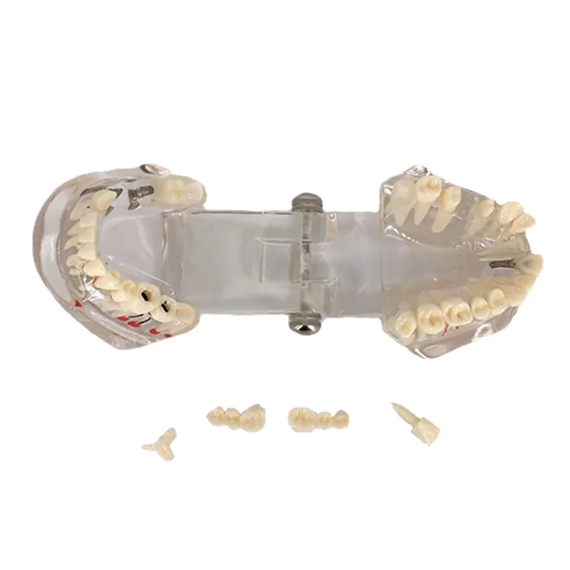 Dental Implant Disease Teeth Model with Restoration Bridge Tooth Dentist for Medical Science Dental Disease Teaching Study