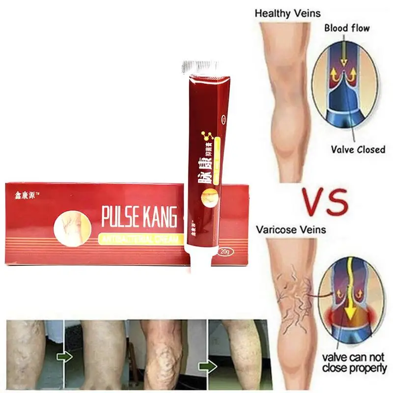 20g Varicose Veins Treatment Cream Ointment Vasculitis Phlebitis Spider Pain Varicosity Angiitis Remedy Removal Herbal Cream