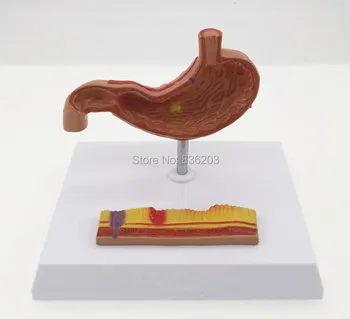 

Diseas of Human Stomach with Ulcers Model in trauma anatomy skeleton anatomical brain skull medical training manikins