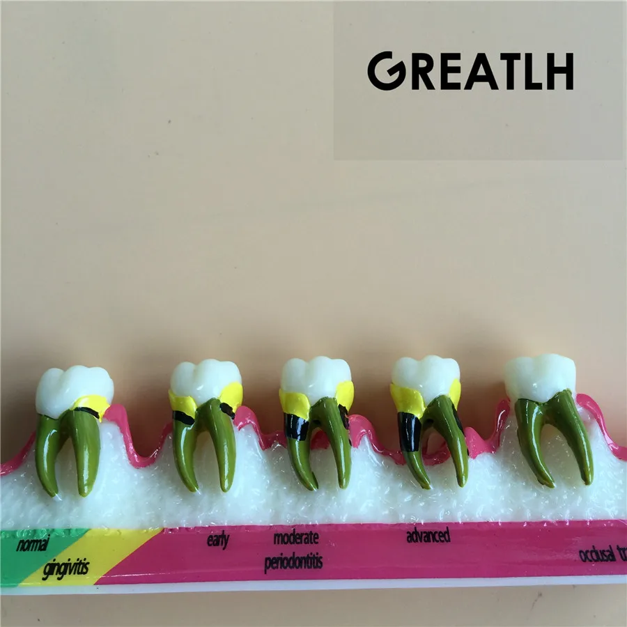 

Dental Teeth Model 5 Stage Periodontal Disease Assort Tooth Classification Model
