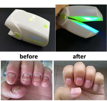 

OEM manufacturer home use 905nm laser treatment for nail fungus laser treatment device with 465nm blue light