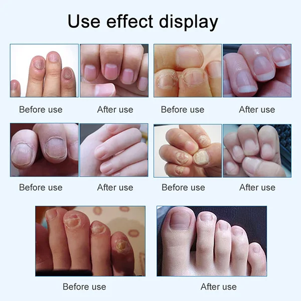 Nail Fungal Treatment Set Onychomycosis Removal Anti Fungus Toenail Nails Care Repair Liquid 25ml HJL2018