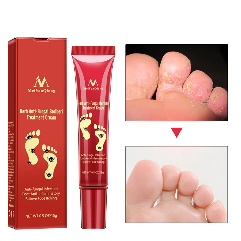 Tratamiento de pies a base de hierbas contra la infección micótica partratamiento eficaz del hongo del dedo del pie Reparación de crema para el cuidado de los pies Tratamiento de pies a base de hierbas contra la infección micótica partratamiento eficaz del hongo del dedo del pie Reparación de crema para el cuidado de los pies
