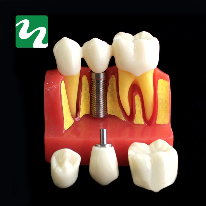 1 предмет 4-раза посадки Зубы Модель устное учение Модель Стоматологическая Патология модель для стоматологии лаборатории