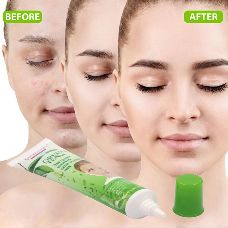 green tea acne cream