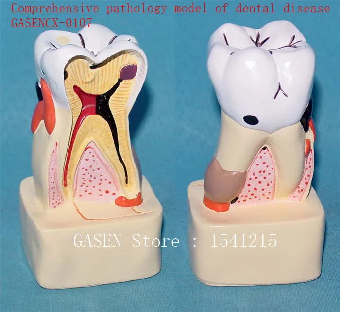 Oral care model Tooth model Teaching model Medical teaching aidsComprehensive pathology model of dental disease - GASENCX-0107 Oral care model Tooth model Teaching model Medical teaching aidsComprehensive pathology model of dental disease - GASENCX-0107