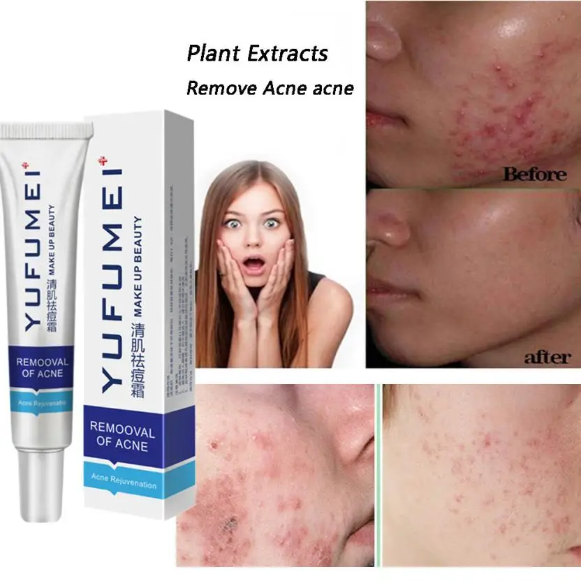 Best moisturizing face cream for oily skin in india 25g Face Skin Care Acne Cream Oil Control Acne Products Face Cream