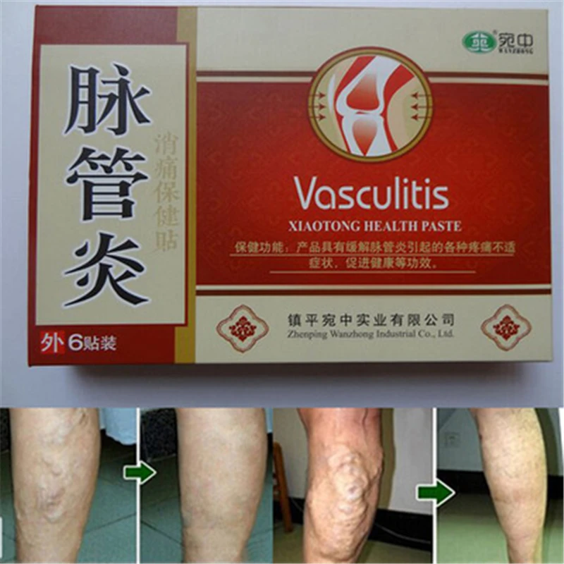

6 Pcs Spider Veins Varicose Treatment Plaster Varicose Veins Cure Patch Vasculitis Natural Herbal Patches,Chinese medicine past