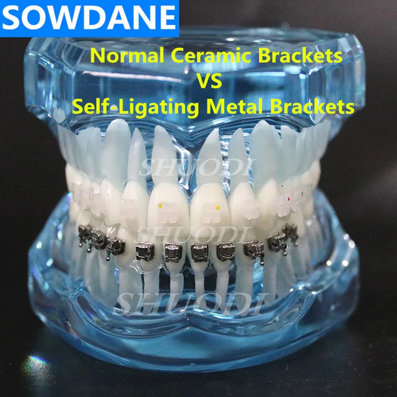 Стоматологический ортодонтический модель с керамическими и самолирующимися металлическими кронштейнами для терпеливого общения