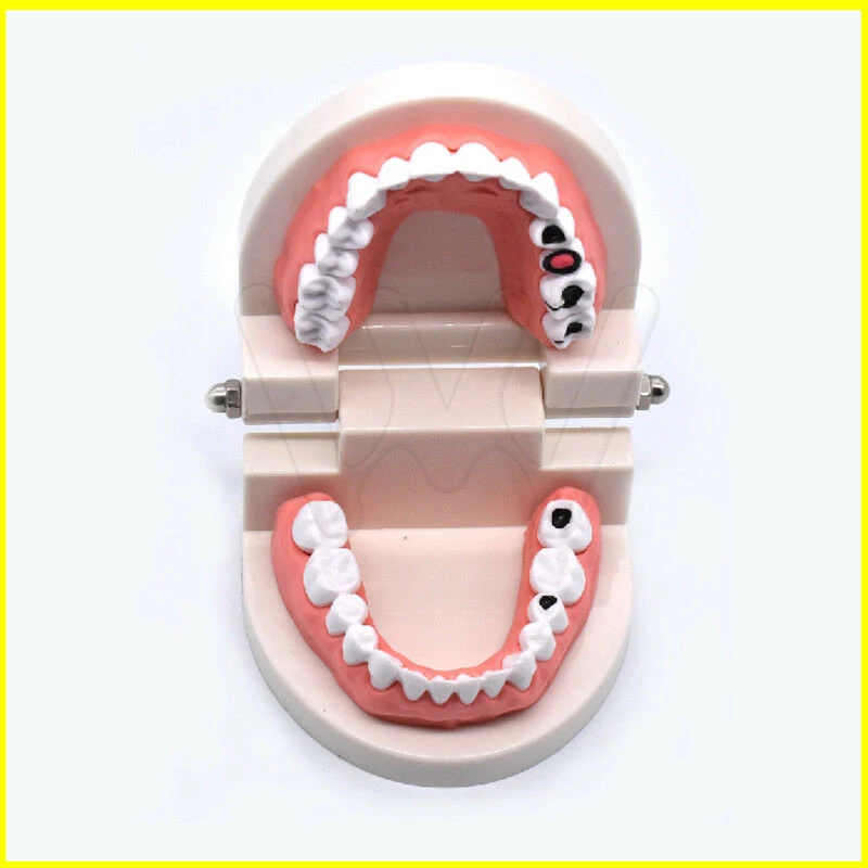 Dental-Study-Teaching-Teeth-Model-Caries-Tooth-Care