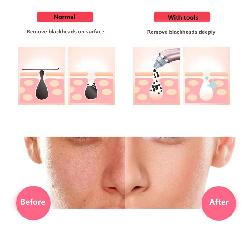 black head remover tool