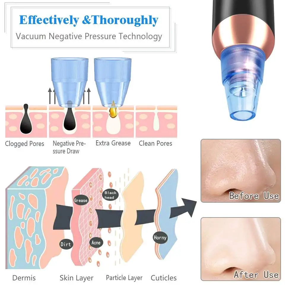 Удалитель угрей пылесос для удаления пор против черных точек всасывающий пилинг акне Инструменты для удаления кожных тегов ручка для удаления черных точек