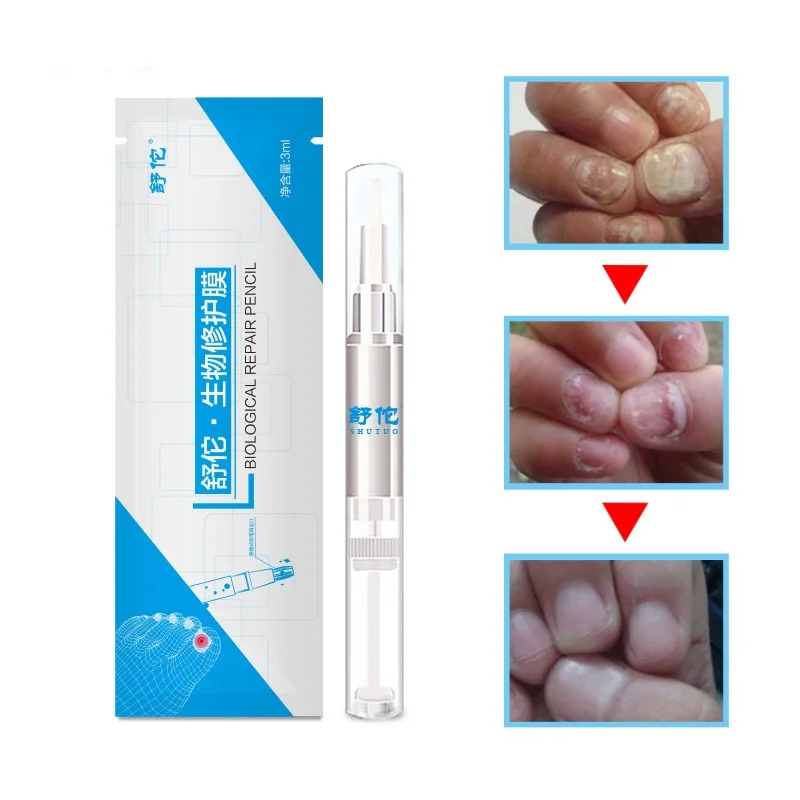 

3ml Fungal Nail Treatment Pen 1 PC Antibacterial Anti Fungal Nail Onychomycosis Herbal Care Medicinal Nutritious Oil Nail Liquid