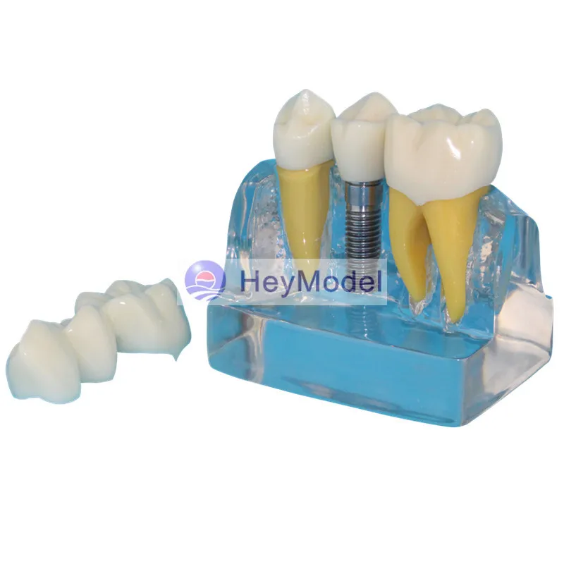 HeyModel Dental implant demonstration model Dentist doctor