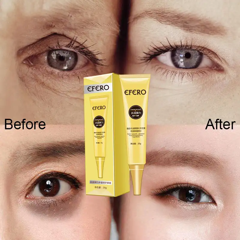 under eye bag removal cream