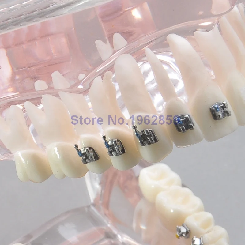 Зубы Модель Ортодонтическая 4 типа кронштейны контраст Металл Керамика лигвальный Invisalign брекеты стоматологический ортодонтический модель