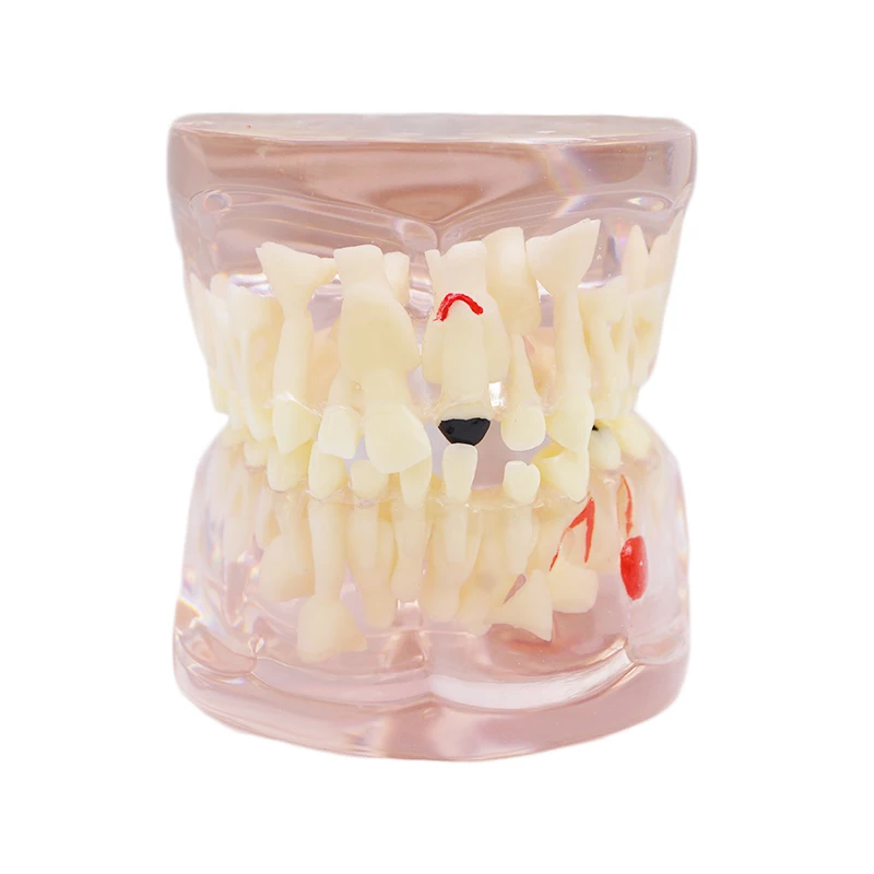 

1PC Dental Study Model Clear Mixed Dentition-Age 7 years Old with Caries Dental Educational Study Model
