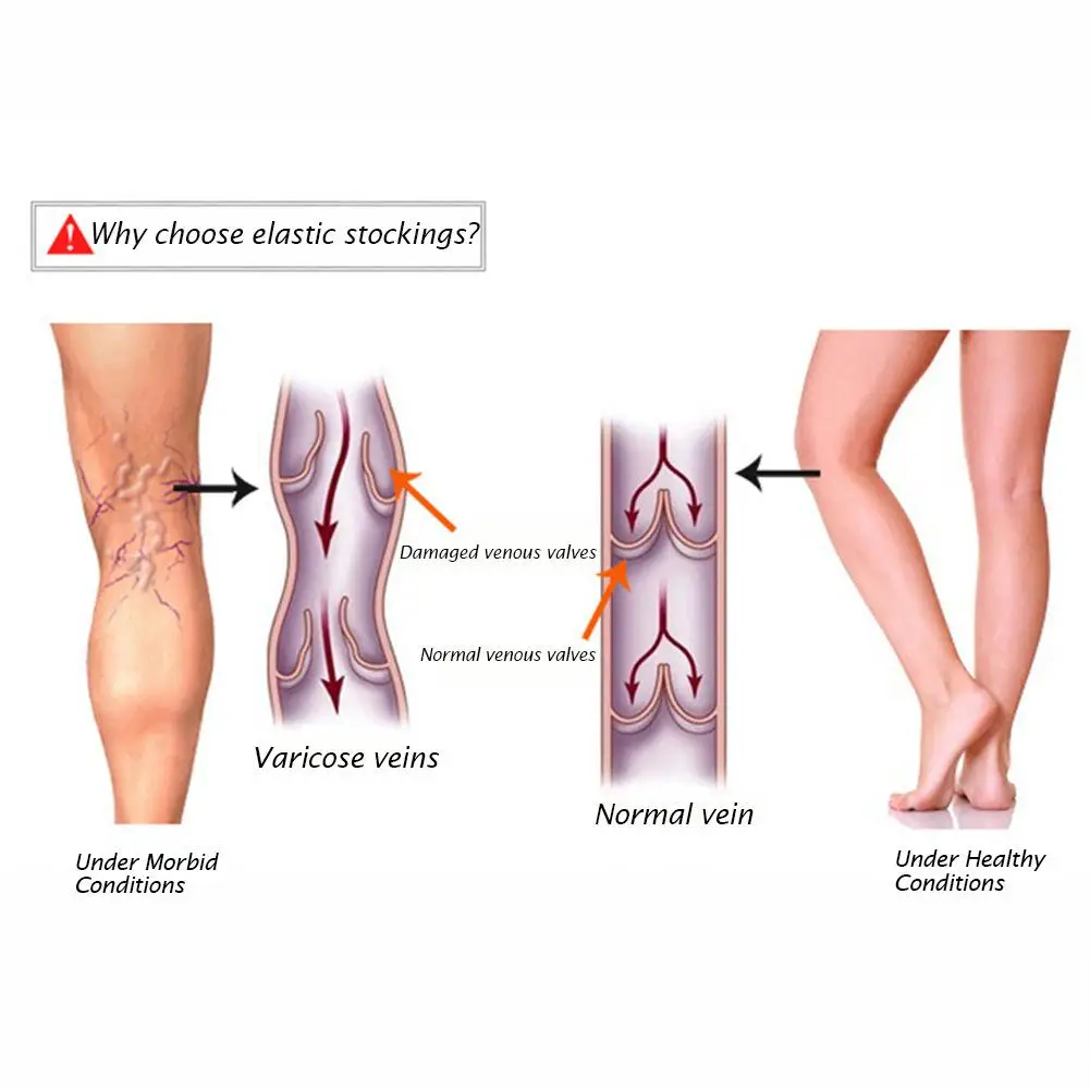 23-32mmHg медицинский Calza Pressione хаки Nero Collant di нейлон Calze A Compressione Calze Tubo Da Stufa