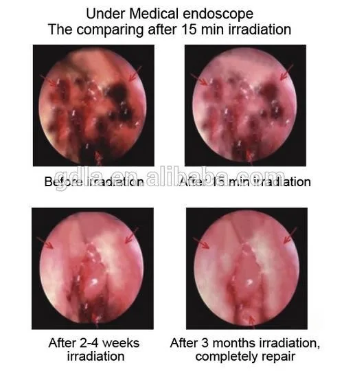 LASTEK фабрика предлагает портативный внутриносовой светильник терапия устройство для ринита, носовых полипов, лечения синусита