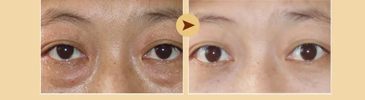 eye mask11