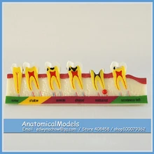 ED-DH1307 Human Tooth Caries Developing Model , Medical Science Educational Dental Teaching Models