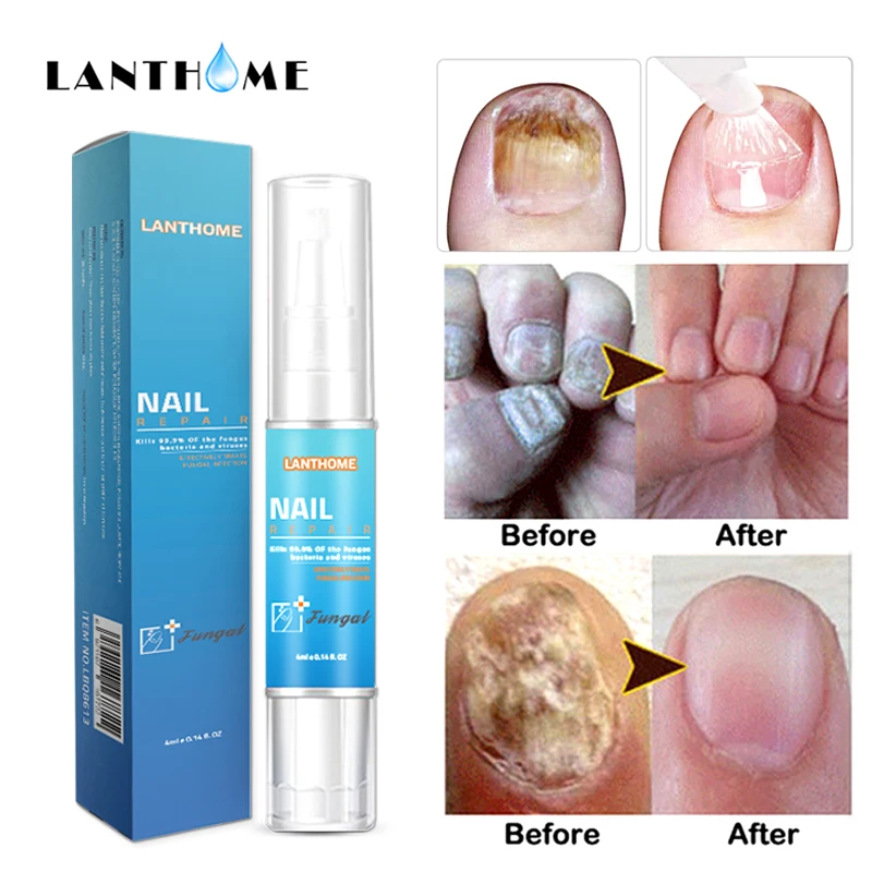  Remover Cuticle Oil Nail Oil Pen The Herb Fungal Nail Repair Bright Cream Disinfection Toe Nail Fun