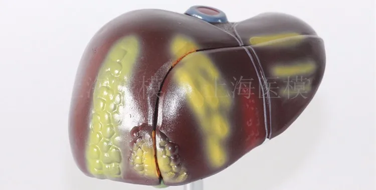 

Liver model liver pathology model fatty liver cirrhosis liver carcinoma model hepatobiliary disease model