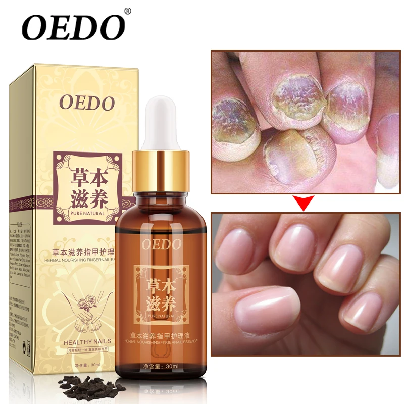 Herbal Fungal Nail Treatment Essential oil Hand and Foot Whitening Toe Nail Fungus Removal Infection Feet Care Polish Nail Gel