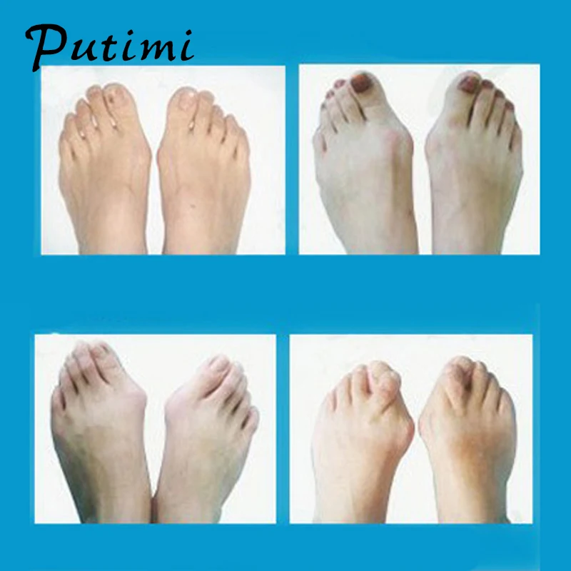 Putimi 2pcs Big Toe Bone Hallux Valgus Correction of Thumb Instruments for Pedicure Bunion Corrector for Toe Separator Foot Care