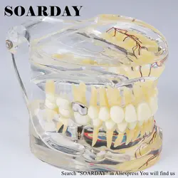 SOARDAY стоматологический взрослый прозрачный патологические зубы модель с зубным нервом и вставками