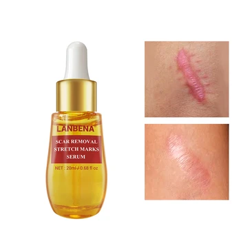 

Acne Scar Remove Serum Acne Treatment Remover Stretch Marks Anti Acne Shrink Pores Blackhead Whitening Cream Skin Care