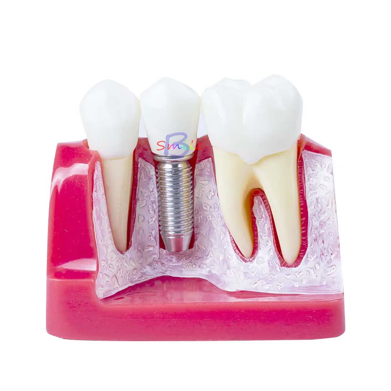 

New Dental Demonstration Teeth Model Implant Analysis Crown Bridge Teeth Model