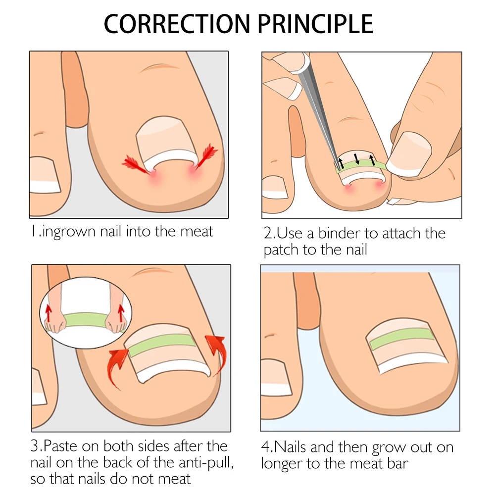 10 шт./кор. Ноготь на пальце ноги вросших коррекции Стикеры патч, ухаживает за кожей стоп коррекция паронихии файл эластичная заплатка корректор Инструменты для обработки