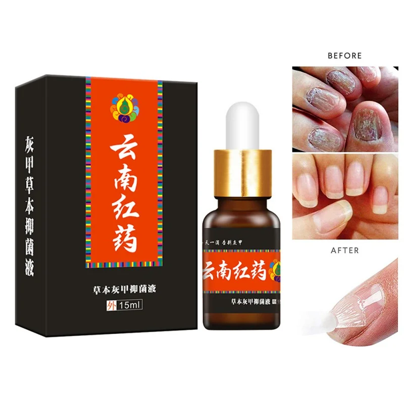 

DUS Nail Fungus Treatment Ointment Treatment Toe Nail Onychomycosis Paronychia Anti Fungal Nail Infection Wholesale