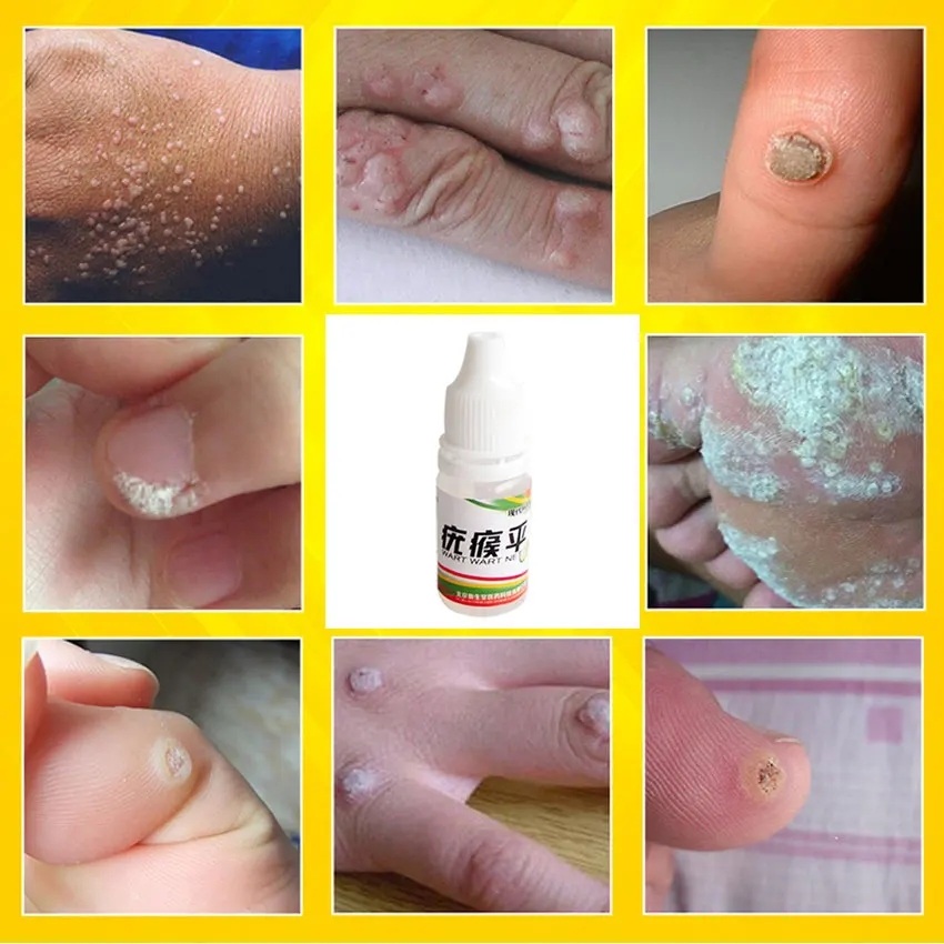 

2019 NEW Upgrade Body Warts Corn Mole Genital Wart Treatment Cream Skin Tag Remover Foot Corn Removal Plantar Warts 10ML