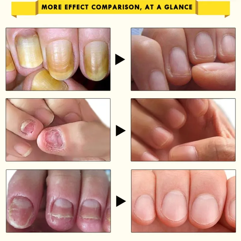 10 мл Лечение грибка для ногтей онихомикоз удаление противогрибковый Уход за ногтями восстанавливающая жидкость