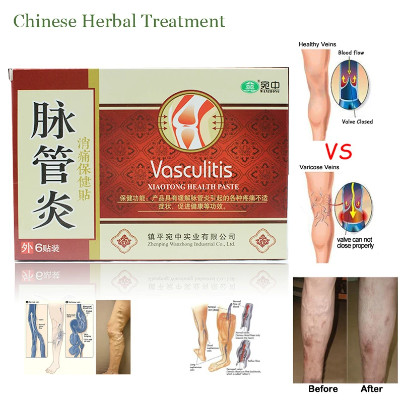 6 PCS Chinese Traditional herbal medicine Patches Cure Spider Veins