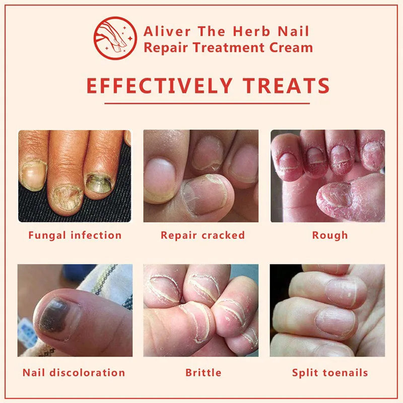 

2018 Nail Repair Cream Nourishing Herb Fingernail Care Treatment Striking Ointment