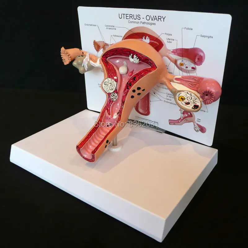 

Pathological Uterus and Ovary Anatomical Model in trauma anatomy skeleton dental anatomical shadow medical training manikins