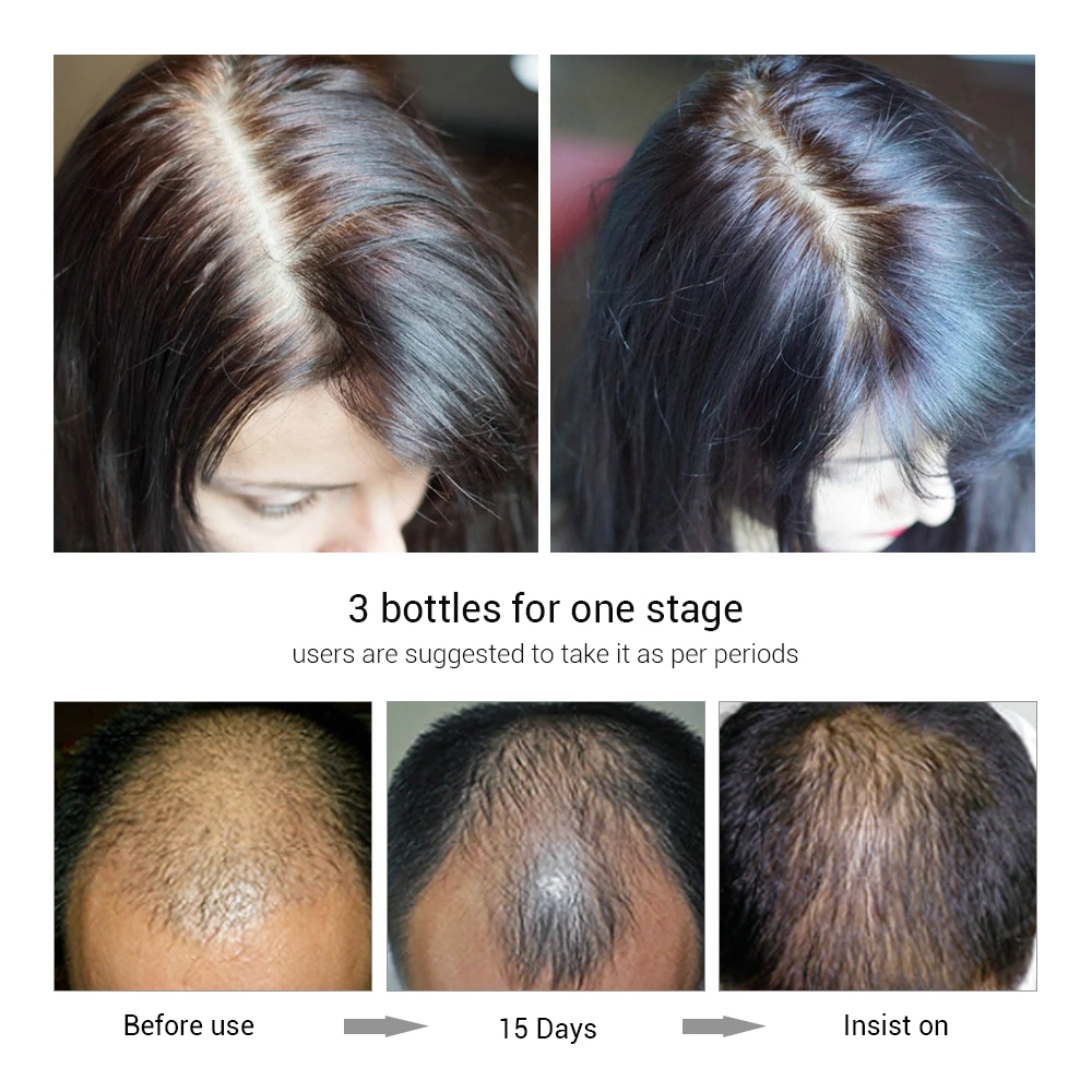 LANBENA Hair Growth Essence Spray Product Preventing Baldness Consolidating Anti Hair Loss Nourish Roots Easy To Carry Hair Care LANBENA Hair Growth Essence Spray Product Preventing Baldness Consolidating Anti Hair Loss Nourish Roots Easy To Carry Hair Care