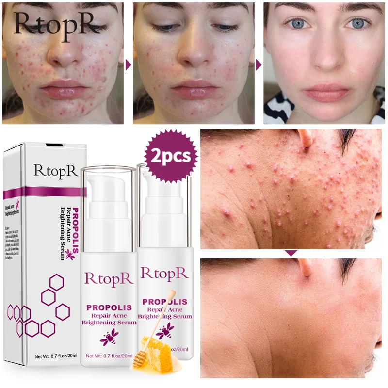 

2 pcs RtopR Propolis Oil Control Acne Serum Repair Acne Scar Cleansing Serum Shrinkage Elimination Acne Treatment Moisturizing