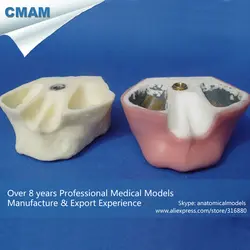 CMAM/12612 Зубной-максиллярный синус, имплантат, анатомическая модель