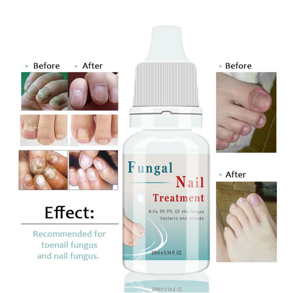 

10ml Herbal Onychomycosis Repair nail Deep Antibacterial Essence Improving Nail Problems Smoother Brighter Nails Care