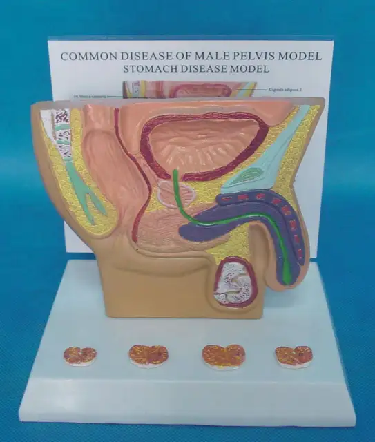 prostata anatomia patologica