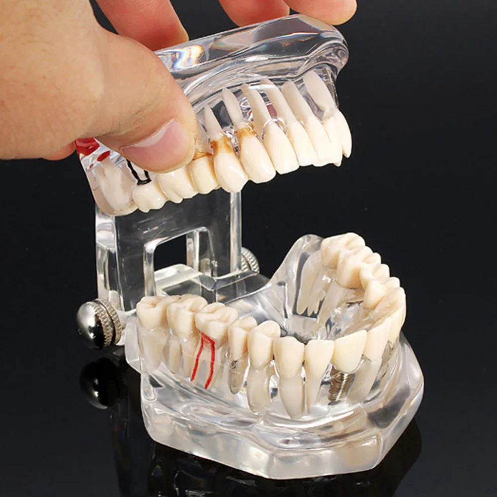 Болезни протезов зубов имплантации модель зубные лабораторное оборудование Гигиена полости рта зубные Инструменты Стоматолог Зубной