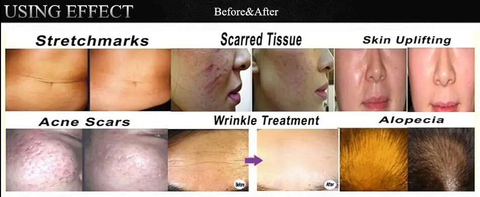 Caneta Derma Baioneta Porta Cartucho Agulha Incluindo 2 Pces x 12pin Agulhas Máquina Elétrica Micro Rolamento Selo Terapia Dr. Mod. 1299345 6 Beleza e saúde